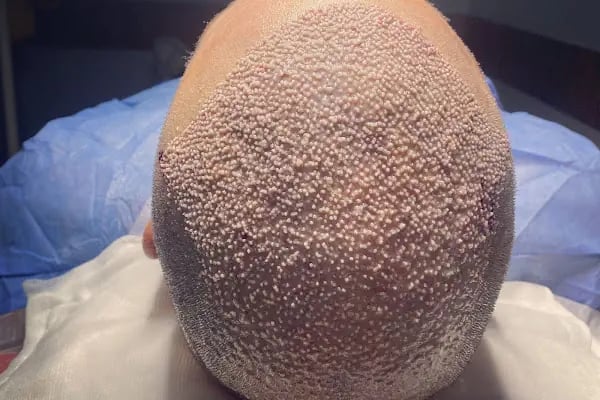 Dr.Gökeşme Hair Transplant - Resim 10