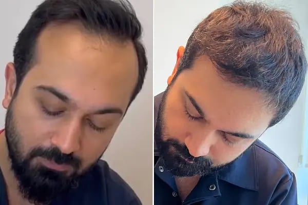 Dr.Gökeşme Hair Transplant - Resim 1