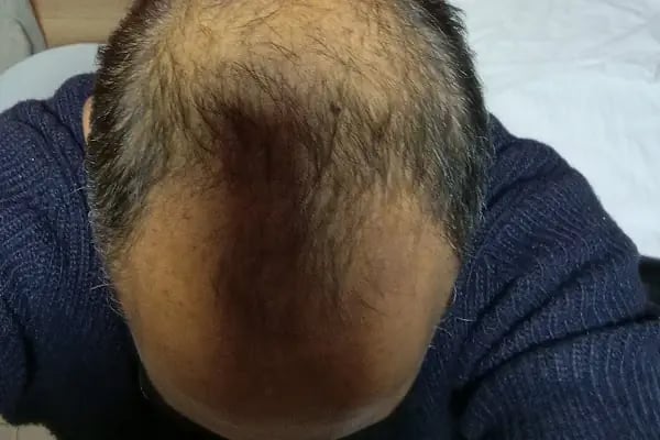 Dr.Gökeşme Hair Transplant - Resim 9