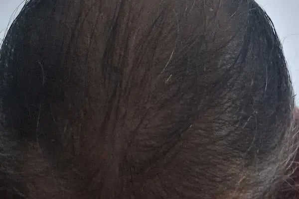 Dr.Gökeşme Hair Transplant - Resim 3