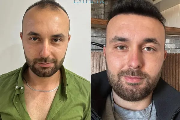 Esteweal Hair Clinic Saç Ekimi - Resim 20