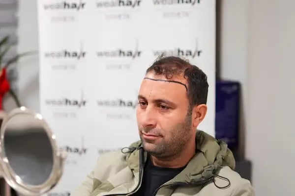 Esteweal Hair Clinic Saç Ekimi - Resim 8