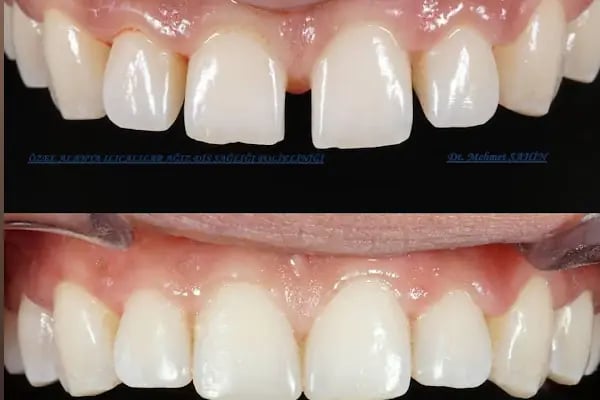 Ilıcalılar Dent - Resim 15