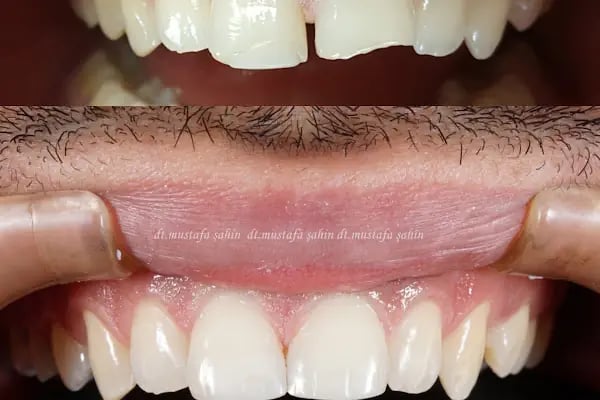 Ilıcalılar Dent - Resim 5