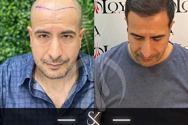 İzmir Saç Ekim Merkezi | Loya Clinic | Fue saç ekimi | İzmir saç PRP ve Mezoterapi | Sakal ekimi | Kaş ekimi - Resim 14