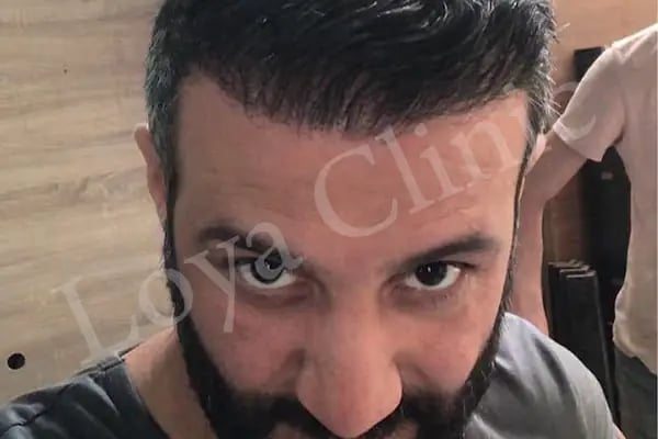 İzmir Saç Ekim Merkezi | Loya Clinic | Fue saç ekimi | İzmir saç PRP ve Mezoterapi | Sakal ekimi | Kaş ekimi - Resim 10