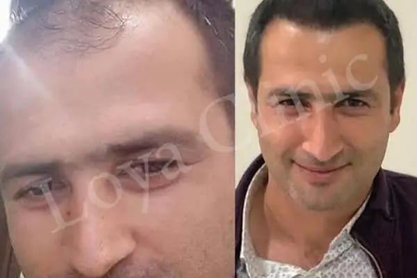 İzmir Saç Ekim Merkezi | Loya Clinic | Fue saç ekimi | İzmir saç PRP ve Mezoterapi | Sakal ekimi | Kaş ekimi - Resim 9