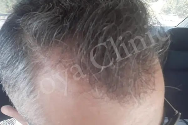İzmir Saç Ekim Merkezi | Loya Clinic | Fue saç ekimi | İzmir saç PRP ve Mezoterapi | Sakal ekimi | Kaş ekimi - Resim 11