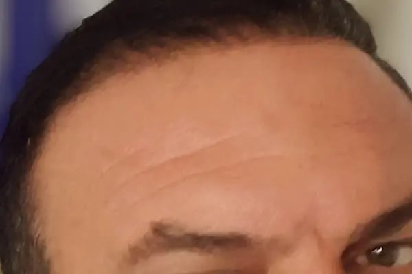 İzmir Saç Ekim Merkezi | Loya Clinic | Fue saç ekimi | İzmir saç PRP ve Mezoterapi | Sakal ekimi | Kaş ekimi - Resim 20