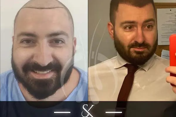 İzmir Saç Ekim Merkezi | Loya Clinic | Fue saç ekimi | İzmir saç PRP ve Mezoterapi | Sakal ekimi | Kaş ekimi - Resim 19