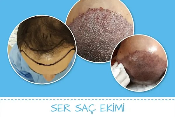 Ser Hair Center - Resim 11