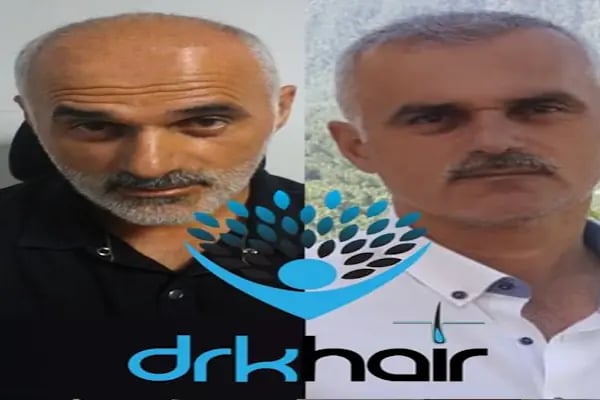 DRKHAIR Saç Ekim Merkezi Antalya - Resim 16