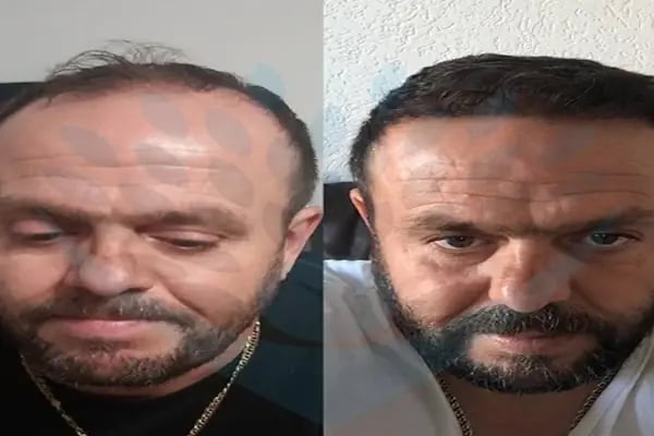 DRKHAIR Saç Ekim Merkezi Antalya - Resim 17