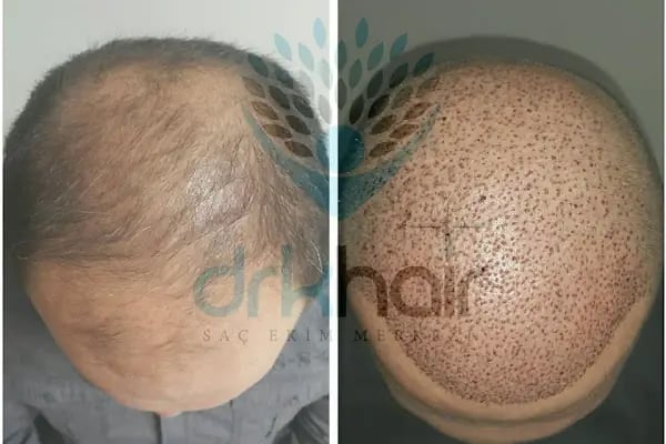 DRKHAIR Saç Ekim Merkezi Antalya - Resim 12