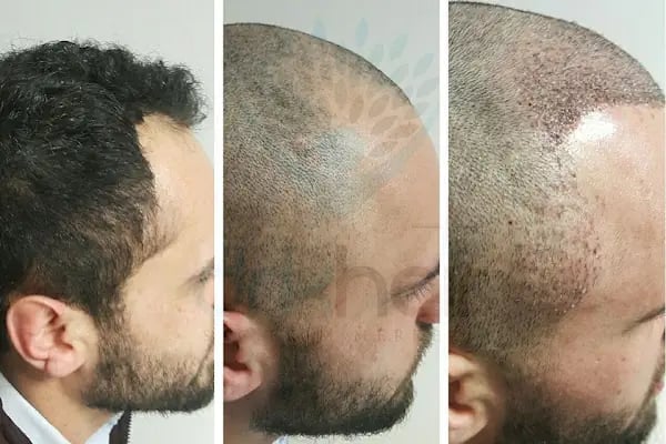 DRKHAIR Saç Ekim Merkezi Antalya - Resim 5