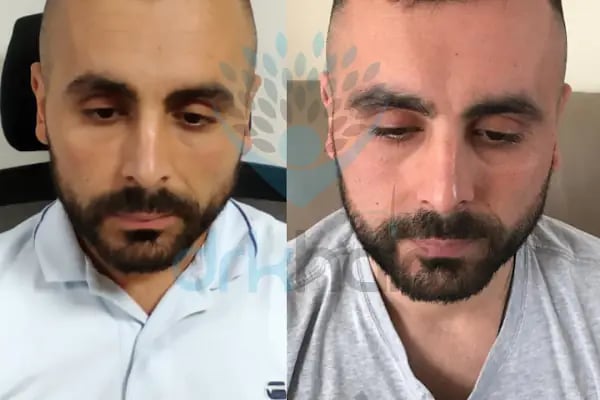 DRKHAIR Saç Ekim Merkezi Antalya - Resim 18