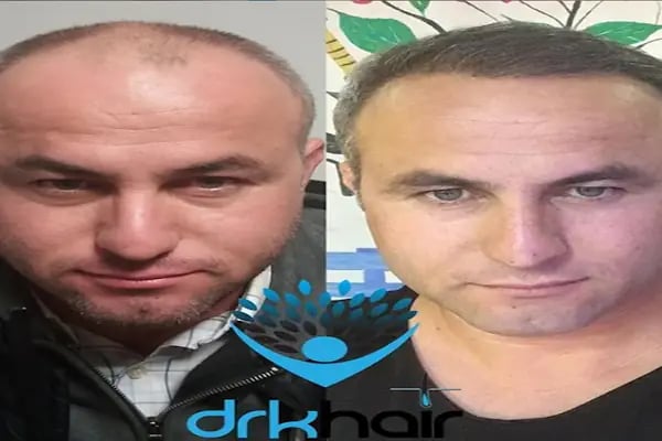 DRKHAIR Saç Ekim Merkezi Antalya - Resim 3