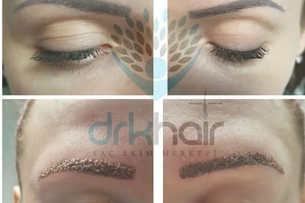 DRKHAIR Saç Ekim Merkezi Antalya - Resim 8