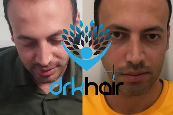 DRKHAIR Saç Ekim Merkezi Antalya - Resim 19