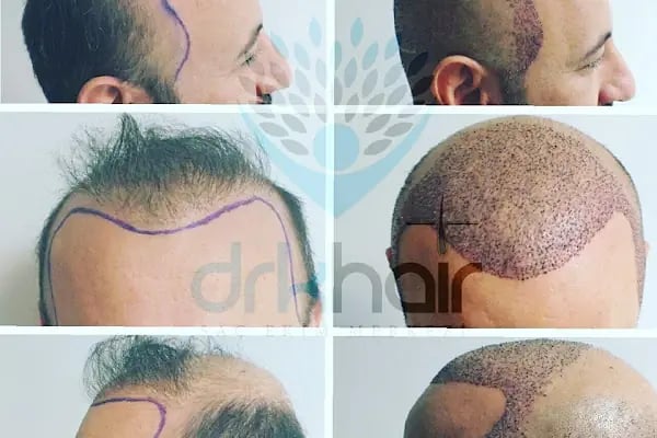 DRKHAIR Saç Ekim Merkezi Antalya - Resim 6