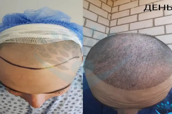 DRKHAIR Saç Ekim Merkezi Antalya - Resim 14