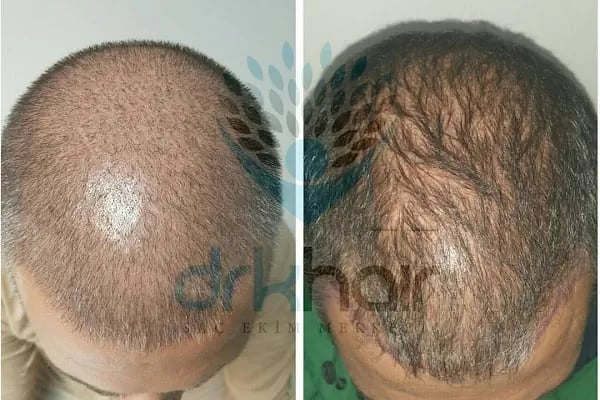 DRKHAIR Saç Ekim Merkezi Antalya - Resim 7