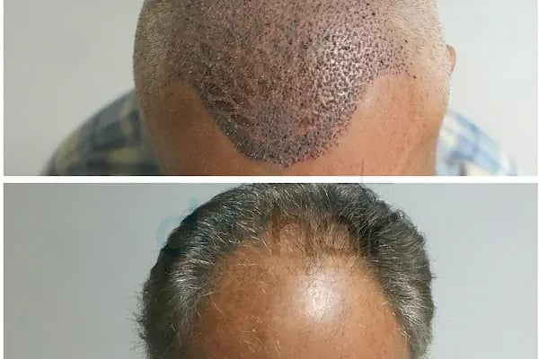 DRKHAIR Saç Ekim Merkezi Antalya - Resim 10