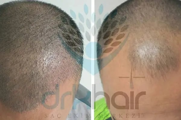 DRKHAIR Saç Ekim Merkezi Antalya - Resim 13