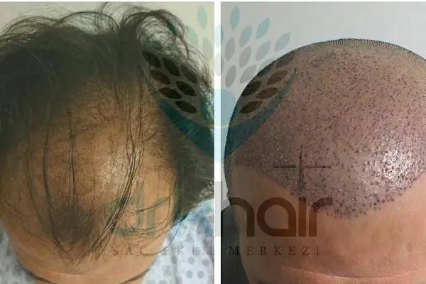 DRKHAIR Saç Ekim Merkezi Antalya - Resim 11