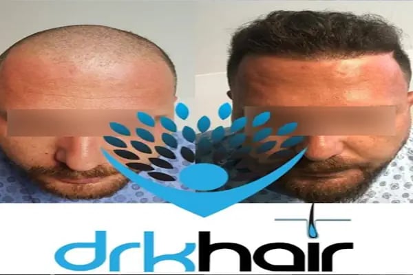 DRKHAIR Saç Ekim Merkezi Antalya - Resim 4