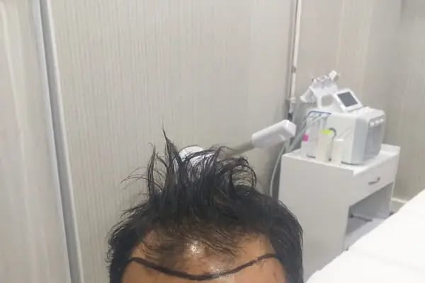 After Hair - Protez Saç Merkezi - Saç Ekim Kliniği - Resim 6