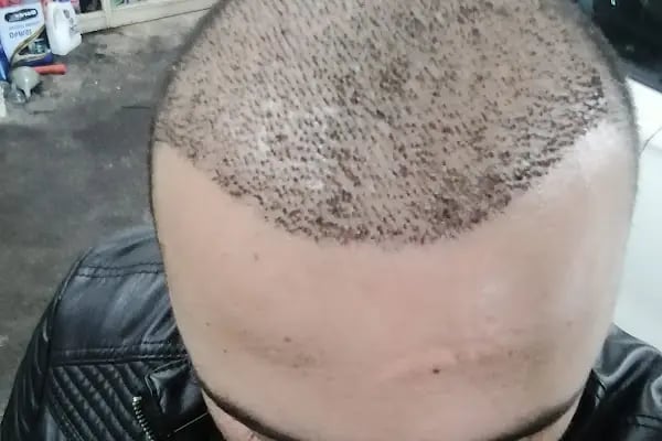 After Hair - Protez Saç Merkezi - Saç Ekim Kliniği - Resim 8