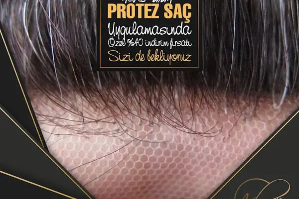 After Hair - Protez Saç Merkezi - Saç Ekim Kliniği - Resim 11