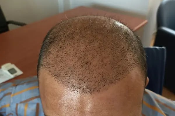 After Hair - Protez Saç Merkezi - Saç Ekim Kliniği - Resim 12