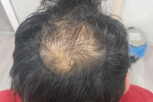 After Hair - Protez Saç Merkezi - Saç Ekim Kliniği - Resim 18