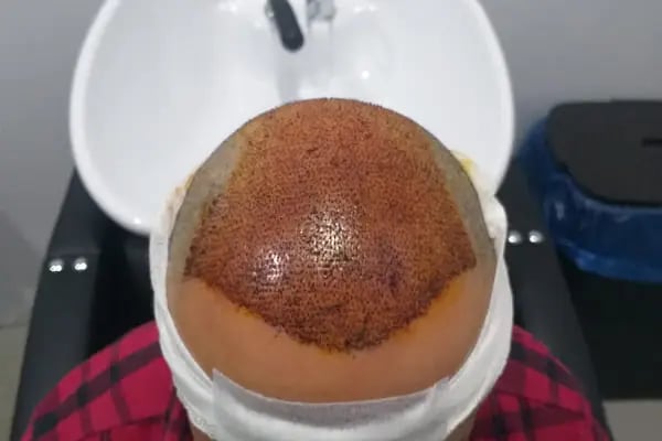 After Hair - Protez Saç Merkezi - Saç Ekim Kliniği - Resim 14