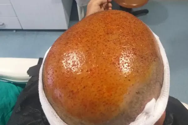 After Hair - Protez Saç Merkezi - Saç Ekim Kliniği - Resim 5