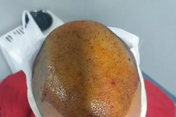 After Hair - Protez Saç Merkezi - Saç Ekim Kliniği - Resim 16