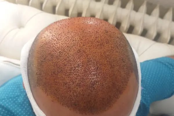 After Hair - Protez Saç Merkezi - Saç Ekim Kliniği - Resim 13