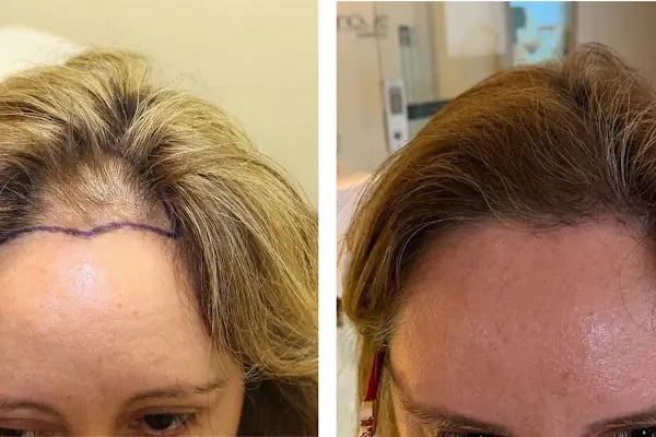 Avicen Hair Transplants, Istanbul - Resim 7