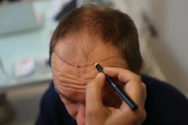 Avicen Hair Transplants, Istanbul - Resim 12