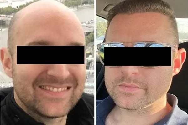 Avicen Hair Transplants, Istanbul - Resim 10