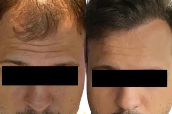 Avicen Hair Transplants, Istanbul - Resim 11