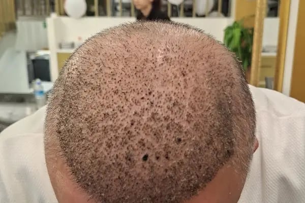 Vialux Hair Transplant | Ankara Saç Ekimi - Resim 4