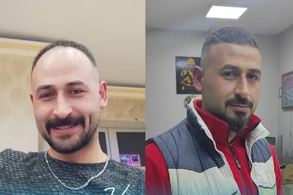 Vialux Hair Transplant | Ankara Saç Ekimi - Resim 10