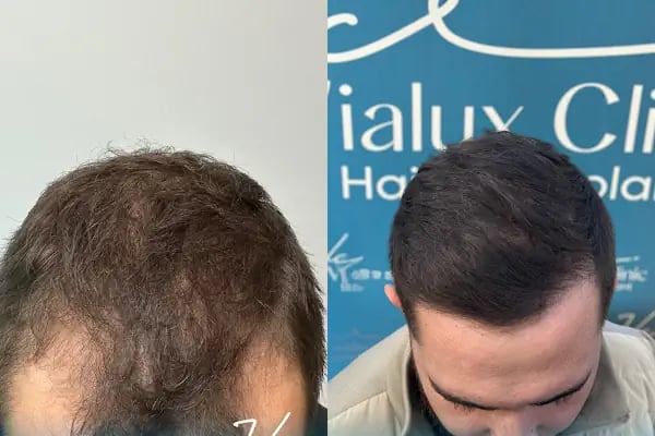 Vialux Hair Transplant | Ankara Saç Ekimi - Resim 5