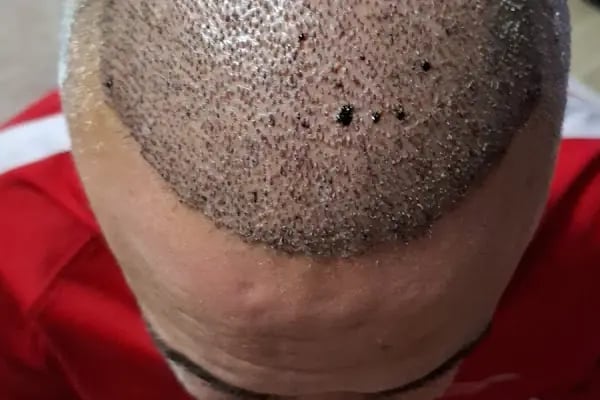 Vialux Hair Transplant | Ankara Saç Ekimi - Resim 3