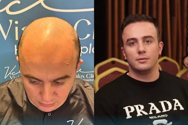 Vialux Hair Transplant | Ankara Saç Ekimi - Resim 11