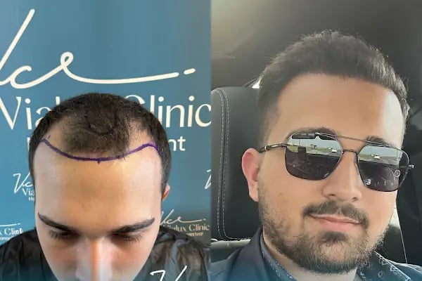 Vialux Hair Transplant | Ankara Saç Ekimi - Resim 9