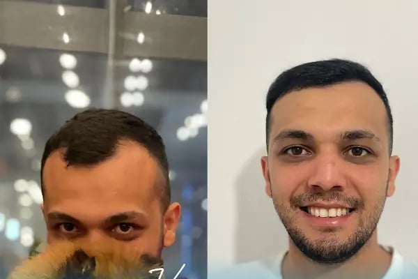 Vialux Hair Transplant | Ankara Saç Ekimi - Resim 7